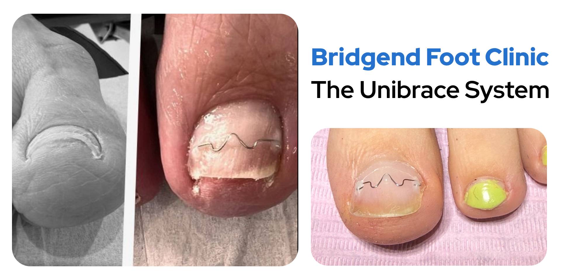 The Unibrace system